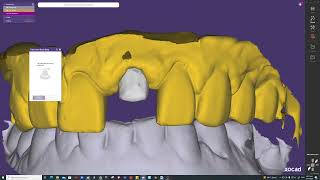 Exocad crown design using impression scan expert mode [upl. by Tomchay]