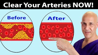 Eat These Foods to Clear Arteries FAST Stop Heart Attacks amp Strokes Dr Mandell [upl. by Gnoz]