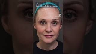 PRF for Under Eyes Treatment  Aesthetic Medicine in Vancouver prf prp [upl. by Patrizius]