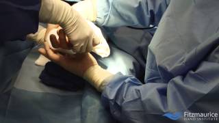 EndoTech® Endoscopic Carpal Tunnel Release  Fitzmaurice Hand Institute [upl. by Inami992]