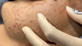 ACNE TREATMENT BO NGUYỄN  Perennial Blackheads On Boy 2024 [upl. by Nivahb306]