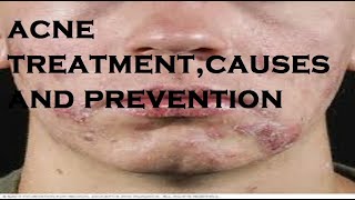 acne treatmentcauses and prevention [upl. by Raveaux]