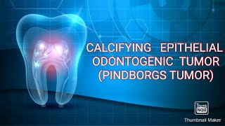 CALCIFYING EPITHELIAL ODONTOGENIC TUMOR PINDBORGS TUMOR [upl. by Engvall646]