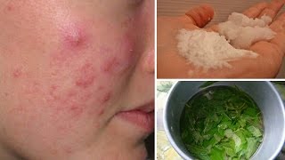 7 Cystic Acne Home Remedies that Really Work [upl. by Eenttirb]