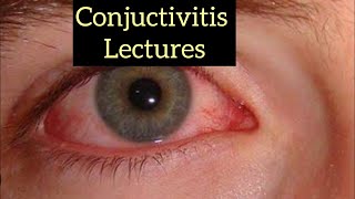 Conjuctivitis part 4 Eye lectures eye jatoi eyelectures conjuctivitis [upl. by Artus]