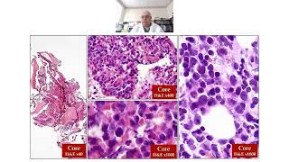 Interesting cases in hematopathology DrJagmohan Sidhu [upl. by Asil]