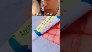 👍 AZELAIC ACID  2 Years Later shorts [upl. by Aixela669]