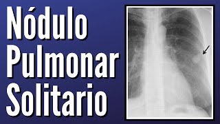 Nódulo Pulmonar Solitario Explicado Claramente [upl. by Stuart68]