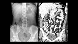 Rx do Abdome Anatomia radiológica [upl. by Trinatte]