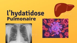 C’est quoi l’Hydatidose Pulmonaire [upl. by Maurilla]