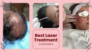 Best Laser treatment at HLCCS RANCHICall now 9334334935 laser skincare beauty laserhairremoval [upl. by Oniger]