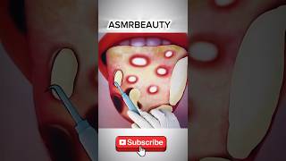 Best Treatment of Tongue infection  ASMR ytshorts youtube [upl. by Scotney]