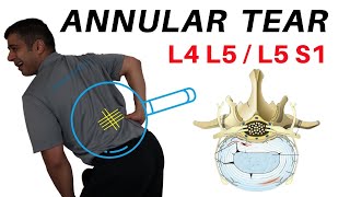 Annular Tear L4L5 L5S1 Disc Bulges [upl. by Eldrid]