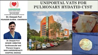 UNIPOTAL VATS FOR PULMONARY HYDATID CYST [upl. by Adnerb]