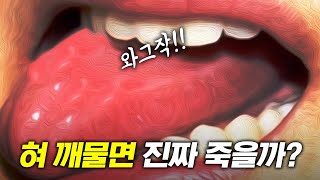 혀만 아플 것 같은데 [upl. by Calle626]