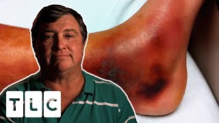 Flesh Eating Bacteria Could Cause Man To Lose His Leg  Monsters Inside Me [upl. by Delgado]