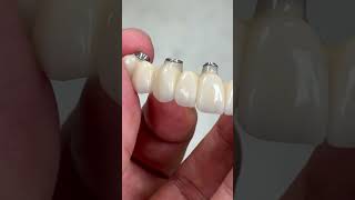 Half full mouth implants zirconia case [upl. by Aihcropal]