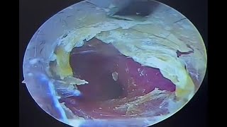 Hard cerumen removal dry pieces on the ear canal and eardrum earwax Cleaning earwaxremoval [upl. by Molloy647]