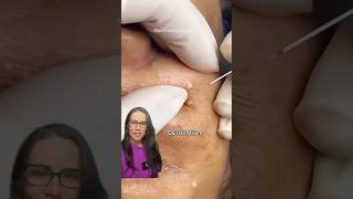 Quistes Milium acne viralvideo facial [upl. by Dihsar]