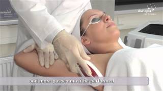 MeDioStar NeXT PRO AleX  Training video for hair removal from Asclepion [upl. by Brice]