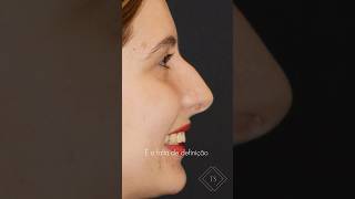 Rinoplastia primária em nariz adunco ✨ [upl. by Cathrin]