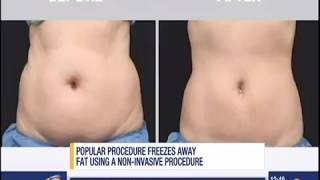 CoolSculpting Treatment on News 12 Connecticut with Before and Afters [upl. by Ainezey]