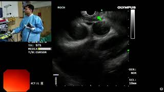 EUS Anatomy of mediastinum [upl. by Other]