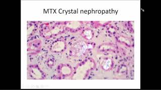 Renal Effects of Chemotherapeutic Agents [upl. by Arlena439]