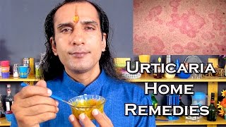 Urticaria Treatment  Urticaria Home Remedies by 2 Kitchen Ingredients [upl. by Aisel]