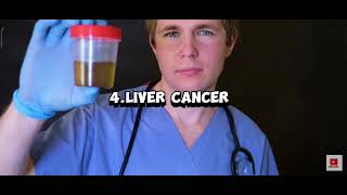 Understanding Liver Disease Symptoms Causes and Prevention  Essential Health Guide [upl. by Alexi916]