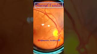 Normal fundus  Normal Retina  Smartphone Fundus Videography  Fundus Photography  Short Video 111 [upl. by Enahsed]