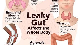 6 Steps to Heal Leaky Gut and Autoimmune Disease Naturally  Health Vlogger [upl. by Pirozzo438]