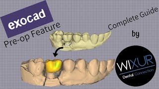 Exocad  Preop feature [upl. by Edea868]