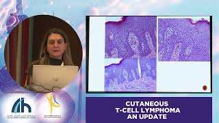 CHALLENGES IN DIAGNOSIS OF MYCOSIS FUNGOIDES  Dr Evangelia Papadavid [upl. by Greyso503]