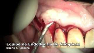 Descolamento de Retalho na Cirurgia Paraendodôntica  Equipe de Endodontia de Campinas [upl. by Ahcsas]