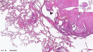 Pulmonary Hamartoma  Histopathology [upl. by Mahgirb]