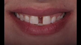 A combined approach for diastema closure [upl. by Drus]