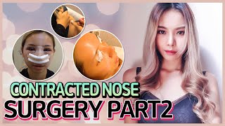 CONTRACTED NOSE REVISION RHINOPLASTY  KOREAN PLASTIC SURGERY VLOG PT2 [upl. by Irpac188]