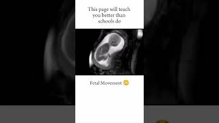 FETAL MOVEMENT😃 short youtubeshorts medical neet [upl. by Wettam]