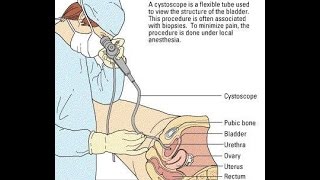 Video Cystoscopy Actual Procedure ENG SUB [upl. by Chas196]