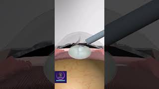 Cataract Surgery  3D Animation [upl. by Strep]