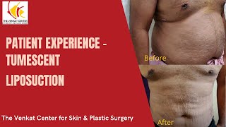 Patient Experience  Tumescent Liposuction at Venkat Center [upl. by Isadora706]