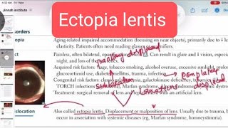 Ectopia lentis Opthalmology 7  First Aid USMLE Step 1 in UrduHindi [upl. by Garold]