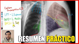 SIGNO DE LA SILUETA  LOCALIZACIÓN DE PATOLOGÍA PULMONAR COMO LEER UNA RADIOGRAFÍA DE TÓRAX [upl. by Ynobe]