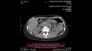 TOMOGRAFIA SIMPLE DE ABDOMEN [upl. by Eolcin592]