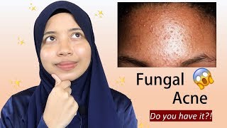 Everything You Need To Know About Fungal Acne [upl. by Ezequiel]