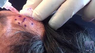 Forehead Lipoma Removal in Mississauga  Dr Michael J Weinberg [upl. by Abra645]