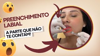 Preenchimento labial com ÁCIDO HIALURÔNICO Recuperação REAL de 7 dias COM VÍDEOS [upl. by Akilaz958]