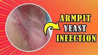 How to treat Armpit yeast infection Candida at home [upl. by Yelrac34]