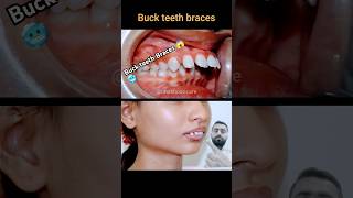 Buck teeth braces process braces orthodontist niengrang dental [upl. by George]